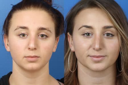 Rhinoplasty/NatraNose Before & After Gallery - Patient 37904787 - Image 3