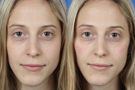 Rhinoplasty/NatraNose Before & After Gallery - Patient 37904793 - Image 2