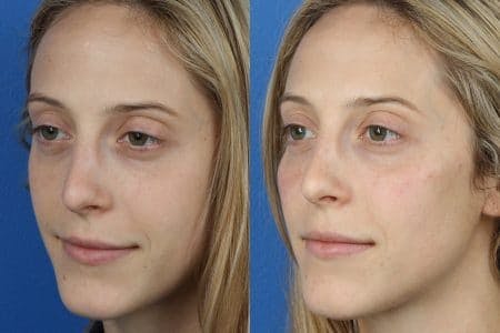 Rhinoplasty/NatraNose Before & After Gallery - Patient 37904793 - Image 3