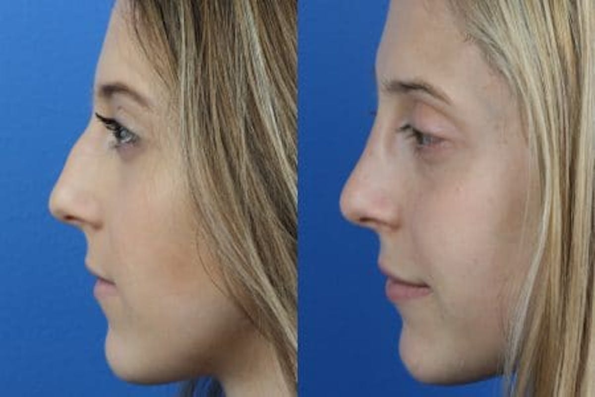 Dermal Fillers Before & After Gallery - Patient 37902368 - Image 3