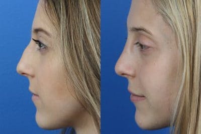 Rhinoplasty/NatraNose Before & After Gallery - Patient 37904793 - Image 1