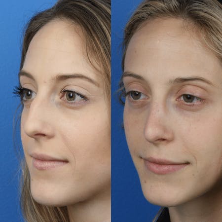 Rhinoplasty/NatraNose Before & After Gallery - Patient 37904793 - Image 4