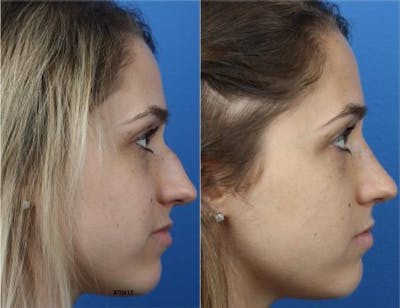 Rhinoplasty/NatraNose Before & After Gallery - Patient 37904797 - Image 1