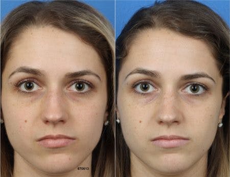 Rhinoplasty/NatraNose Before & After Gallery - Patient 37904797 - Image 2