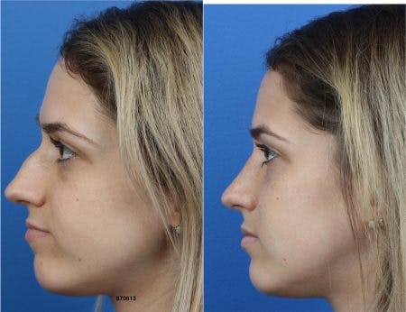 Rhinoplasty/NatraNose Before & After Gallery - Patient 37904797 - Image 3