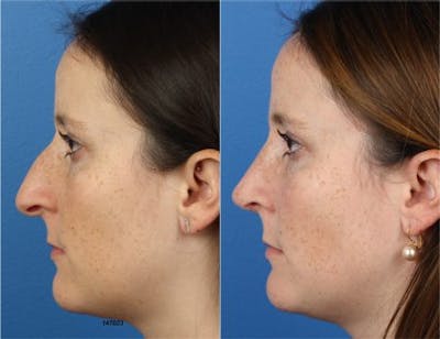 Rhinoplasty/NatraNose Before & After Gallery - Patient 37904800 - Image 1