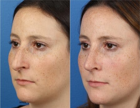 Rhinoplasty/NatraNose Before & After Gallery - Patient 37904800 - Image 2