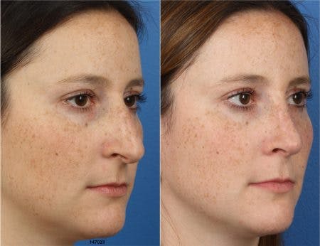 Rhinoplasty/NatraNose Before & After Gallery - Patient 37904800 - Image 3