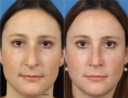 Rhinoplasty/NatraNose Before & After Gallery - Patient 37904800 - Image 4