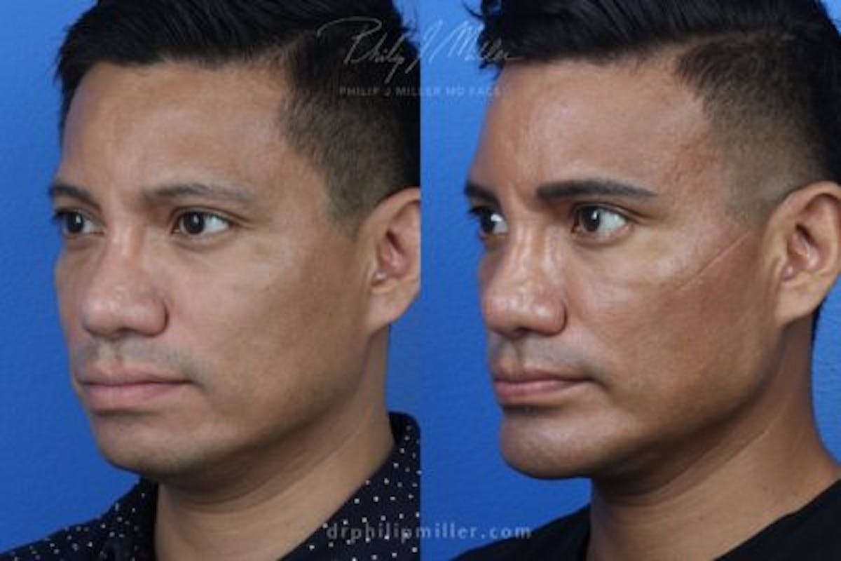 Neck Liposuction Before & After Gallery - Patient 37904801 - Image 4