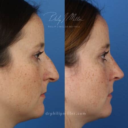 Rhinoplasty/NatraNose Before & After Gallery - Patient 37904800 - Image 5