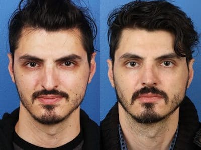 Rhinoplasty/NatraNose Before & After Gallery - Patient 37904811 - Image 1