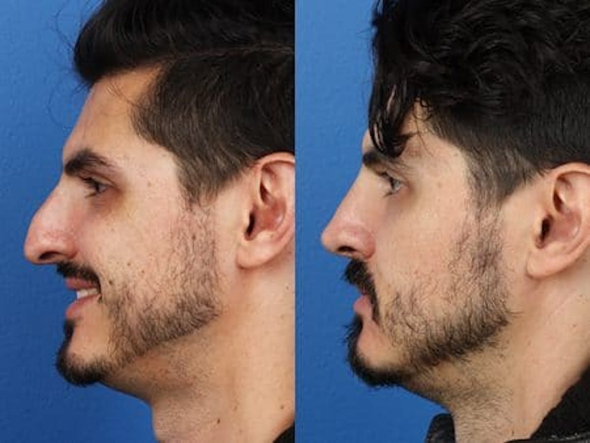Ethnic Rhinoplasty Before & After Gallery - Patient 37903763 - Image 1