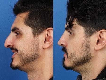 Rhinoplasty/NatraNose Before & After Gallery - Patient 37904811 - Image 2