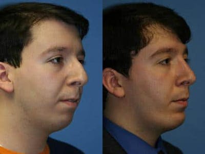 Neck Liposuction Before & After Gallery - Patient 37904814 - Image 1