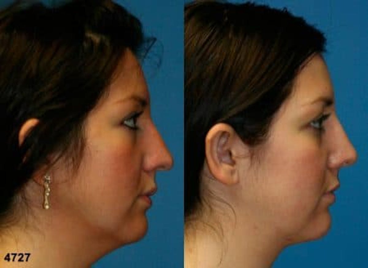 Neck Liposuction Before & After Gallery - Patient 37904817 - Image 1