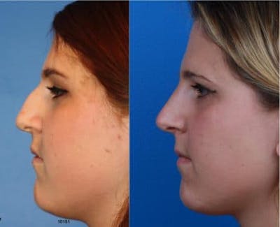Rhinoplasty/NatraNose Before & After Gallery - Patient 37904818 - Image 1