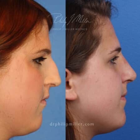 Rhinoplasty/NatraNose Before & After Gallery - Patient 37904818 - Image 2