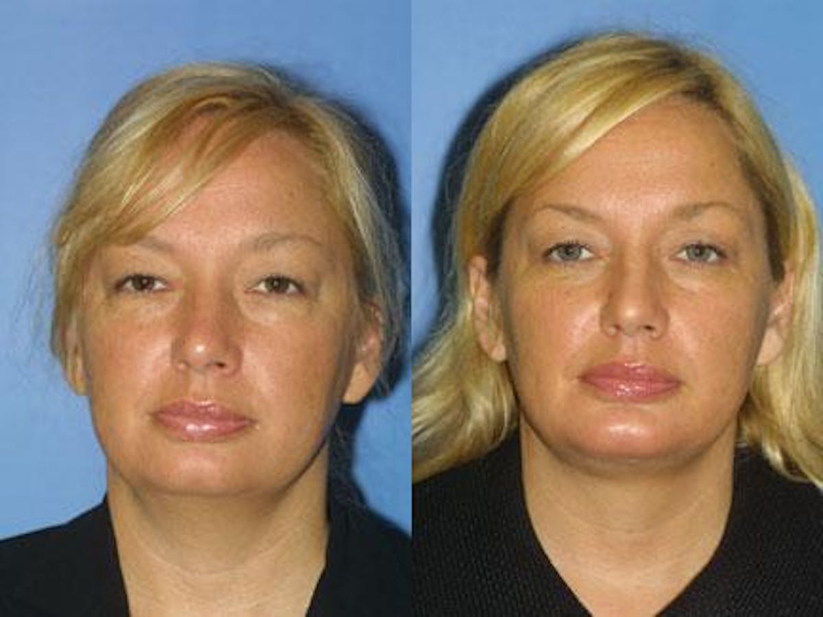 Blepharoplasty/NatraEye Before & After Gallery - Patient 37901903 - Image 2