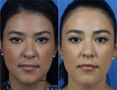 Rhinoplasty/NatraNose Before & After Gallery - Patient 37904822 - Image 2