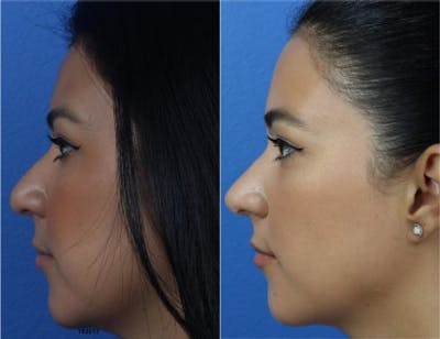 Rhinoplasty/NatraNose Before & After Gallery - Patient 37904822 - Image 1