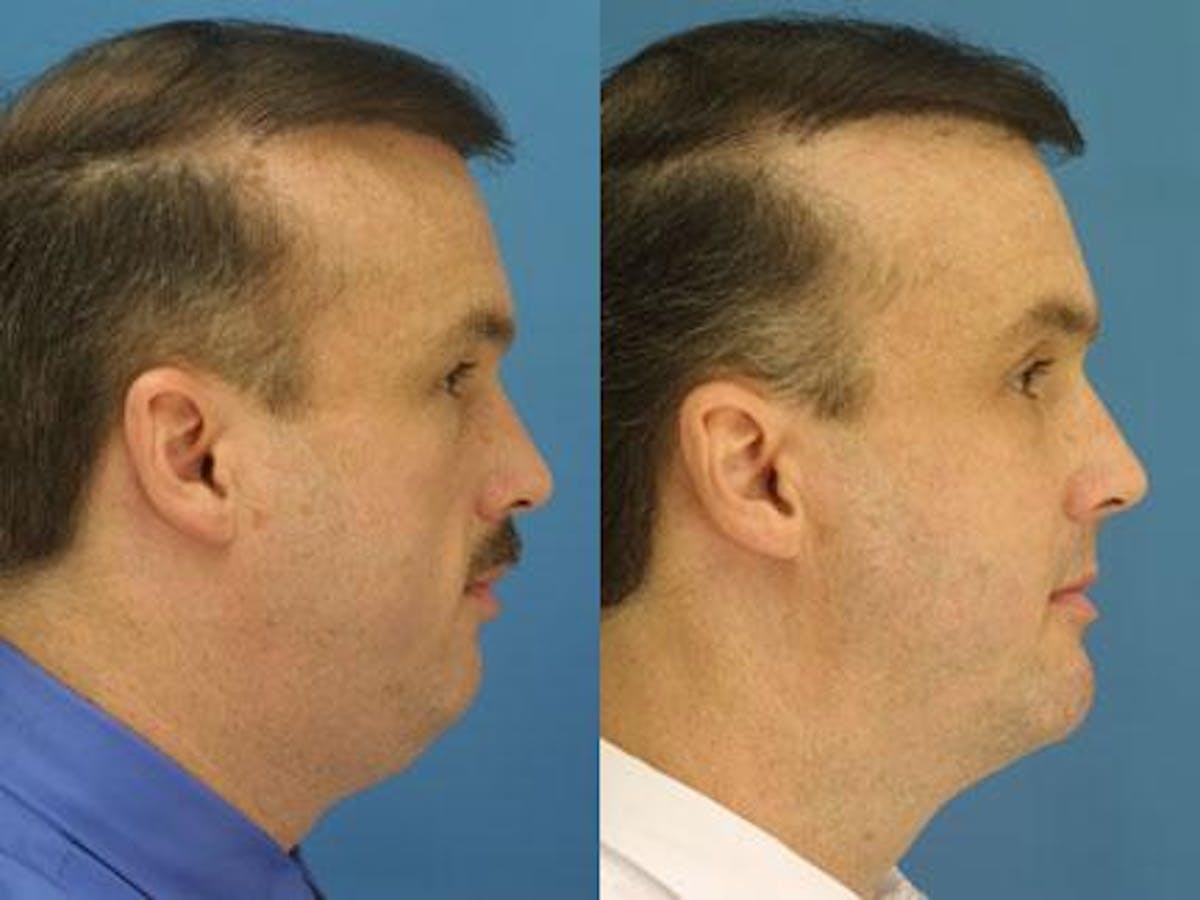 Neck Liposuction Before & After Gallery - Patient 37904823 - Image 2