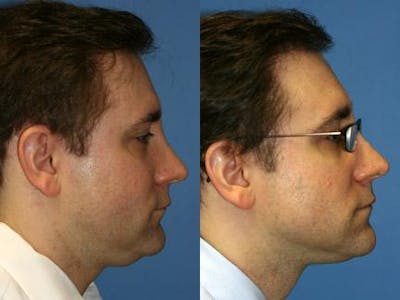 Neck Liposuction Before & After Gallery - Patient 37904826 - Image 1