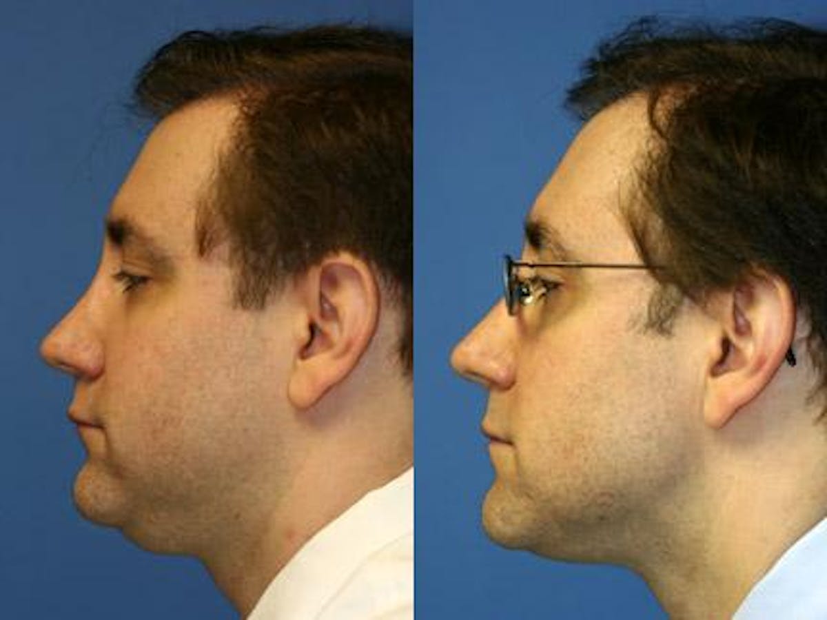 Neck Liposuction Before & After Gallery - Patient 37904826 - Image 2