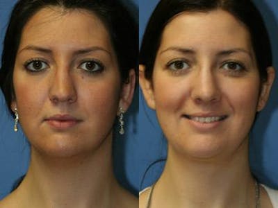 Neck Liposuction Before & After Gallery - Patient 37904830 - Image 1