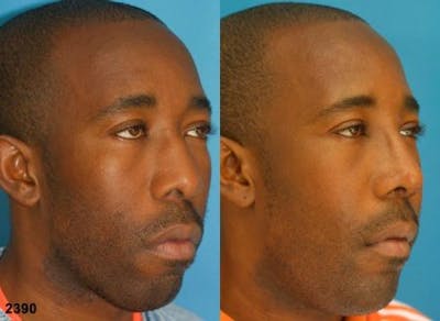 Rhinoplasty/NatraNose Before & After Gallery - Patient 37904833 - Image 1
