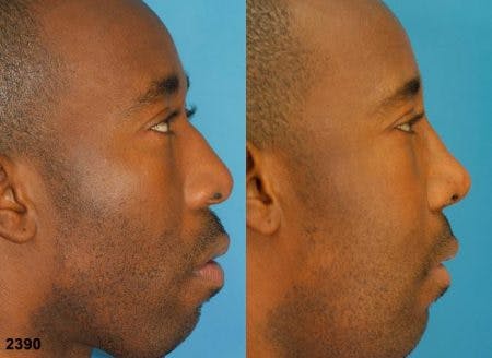 Rhinoplasty/NatraNose Before & After Gallery - Patient 37904833 - Image 2
