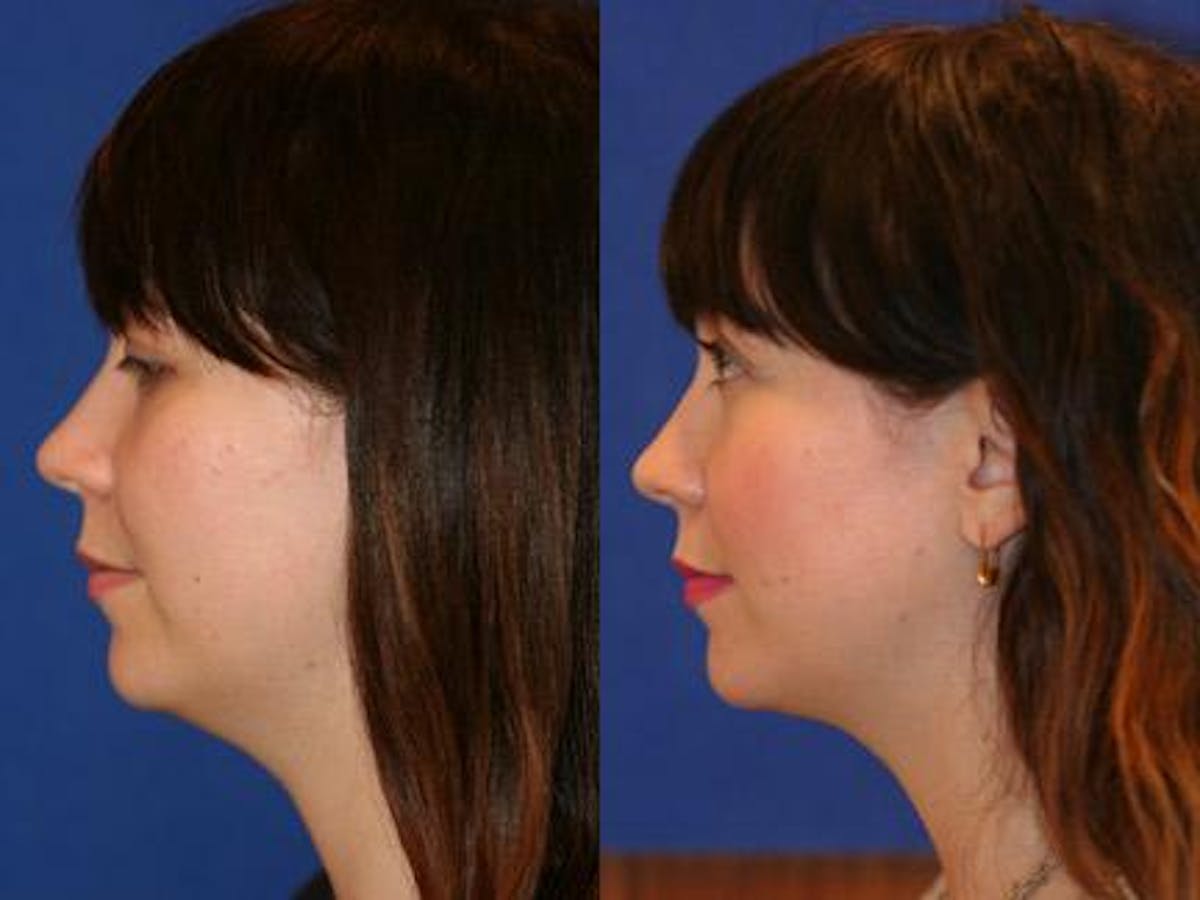 Neck Liposuction Before & After Gallery - Patient 37904835 - Image 2
