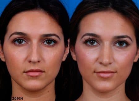 Rhinoplasty/NatraNose Before & After Gallery - Patient 37904839 - Image 2