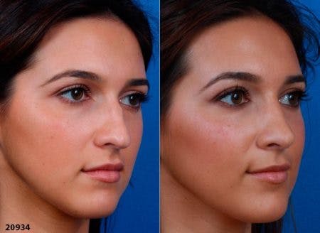 Rhinoplasty/NatraNose Before & After Gallery - Patient 37904839 - Image 3