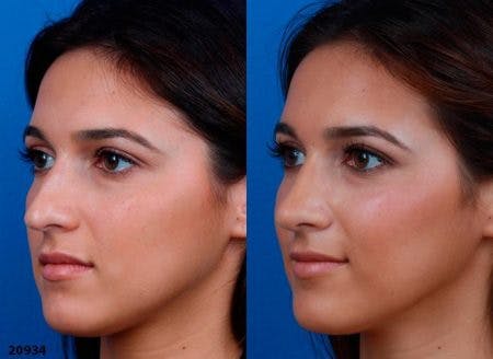 Rhinoplasty/NatraNose Before & After Gallery - Patient 37904839 - Image 4