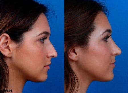Rhinoplasty/NatraNose Before & After Gallery - Patient 37904839 - Image 5