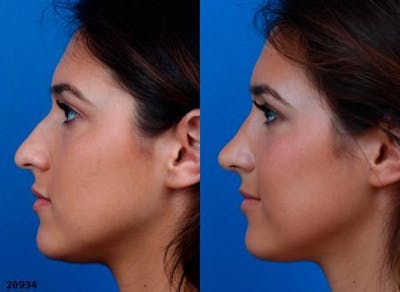 Rhinoplasty/NatraNose Before & After Gallery - Patient 37904839 - Image 1