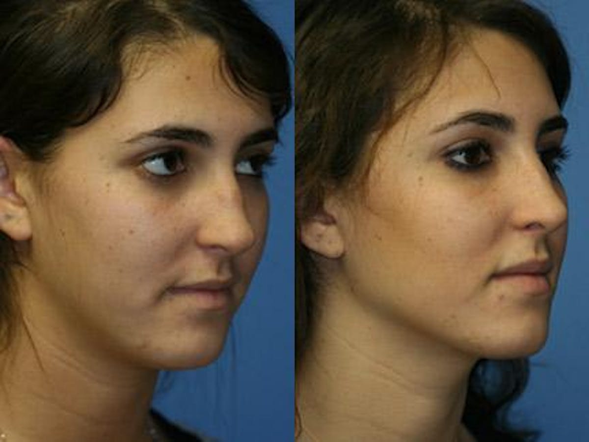 Revision Rhinoplasty Before & After Gallery - Patient 37904255 - Image 2
