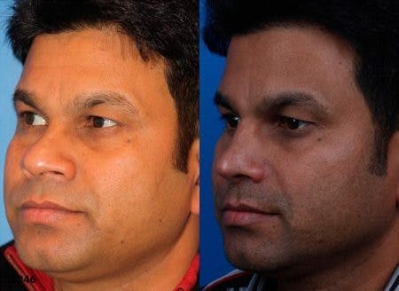 Rhinoplasty/NatraNose Before & After Gallery - Patient 37904852 - Image 2