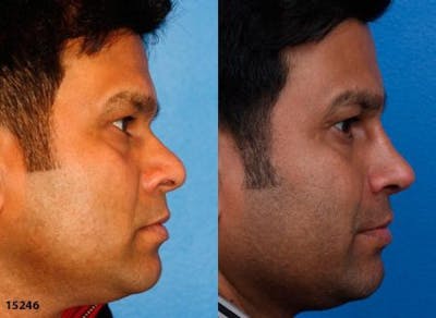 Ethnic Rhinoplasty Before & After Gallery - Patient 37903872 - Image 1