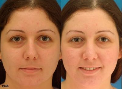 Rhinoplasty/NatraNose Before & After Gallery - Patient 37904856 - Image 1