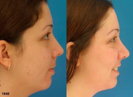 Rhinoplasty/NatraNose Before & After Gallery - Patient 37904856 - Image 2