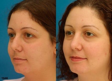 Rhinoplasty/NatraNose Before & After Gallery - Patient 37904856 - Image 3