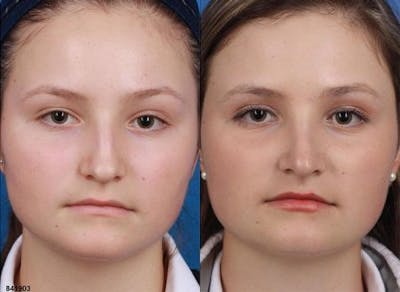 Rhinoplasty/NatraNose Before & After Gallery - Patient 37904859 - Image 1