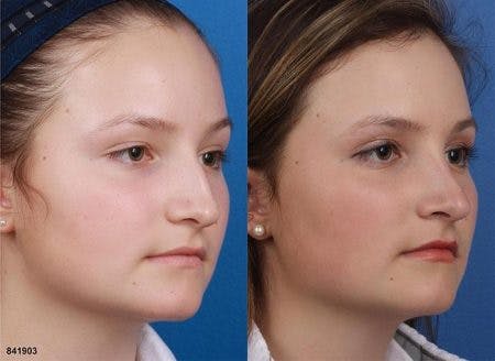 Rhinoplasty/NatraNose Before & After Gallery - Patient 37904859 - Image 2