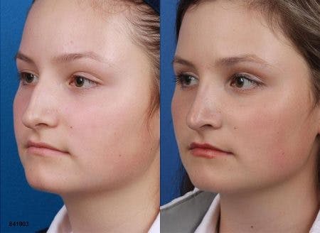Rhinoplasty/NatraNose Before & After Gallery - Patient 37904859 - Image 3