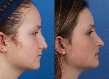 Rhinoplasty/NatraNose Before & After Gallery - Patient 37904859 - Image 4