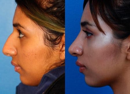 Rhinoplasty/NatraNose Before & After Gallery - Patient 37904864 - Image 2