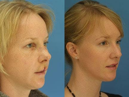 Rhinoplasty/NatraNose Before & After Gallery - Patient 37904867 - Image 2