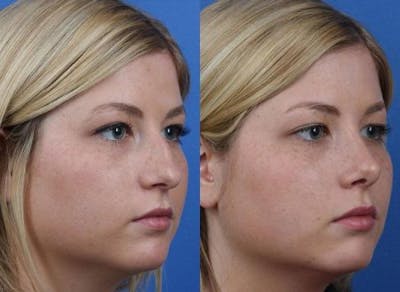 Rhinoplasty/NatraNose Before & After Gallery - Patient 37904869 - Image 1